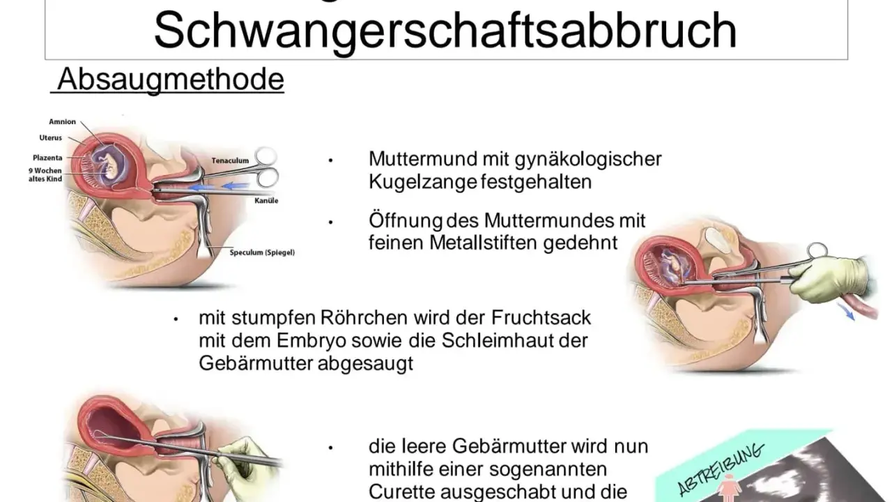 Illustrationen zeigen den Ablauf einer Absaugung bei einem Schwangerschaftsabbruch, von der Öffnung des Muttermundes bis zum Absaugen des Fruchtsacks.