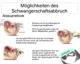 Illustrationen zeigen den Ablauf einer Absaugung bei einem Schwangerschaftsabbruch, von der Öffnung des Muttermundes bis zum Absaugen des Fruchtsacks.