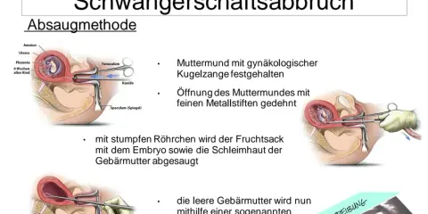 Illustrationen zeigen den Ablauf einer Absaugung bei einem Schwangerschaftsabbruch, von der Öffnung des Muttermundes bis zum Absaugen des Fruchtsacks.