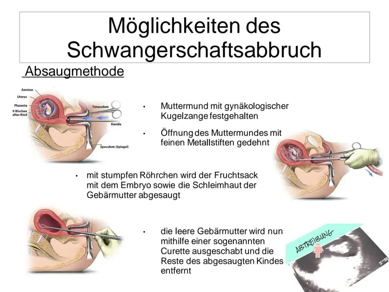 Illustrationen zeigen den Ablauf einer Absaugung bei einem Schwangerschaftsabbruch, von der Öffnung des Muttermundes bis zum Absaugen des Fruchtsacks.